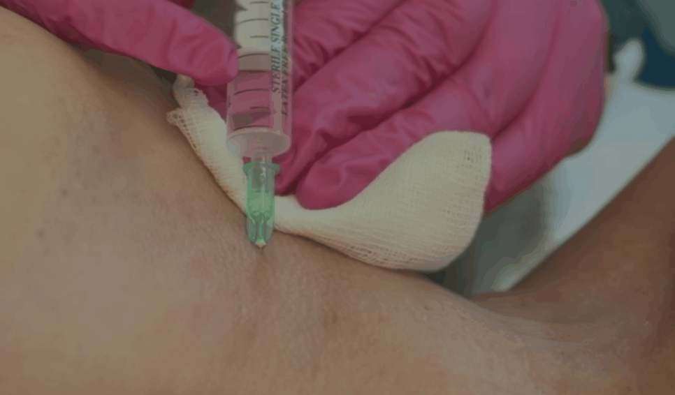 mezoterapia igłowa anti-age kosmetolog słowiak premium clinic nawilżenie